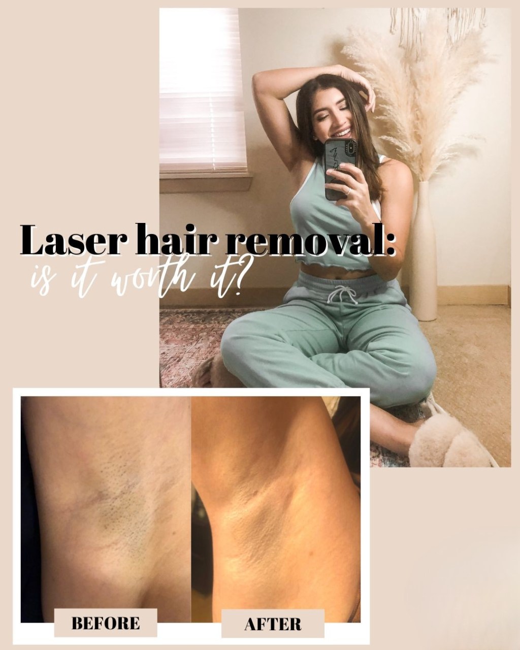 Laser hair removal: Is it worth it? Here’s my experience.